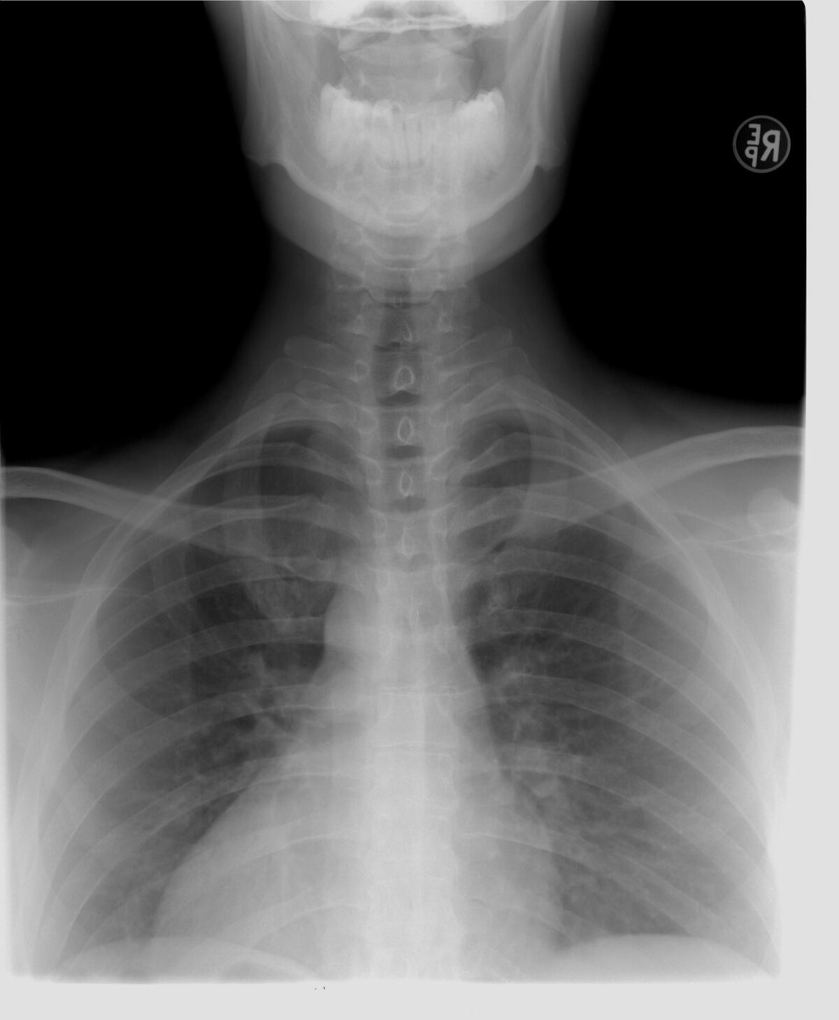 Снимок. Рентгенография грудной клетки позвоночника. Рентген грудного отдела позвоночника. Рентген верхнегрудного отделов позвоночника. Рентгеновские снимки.